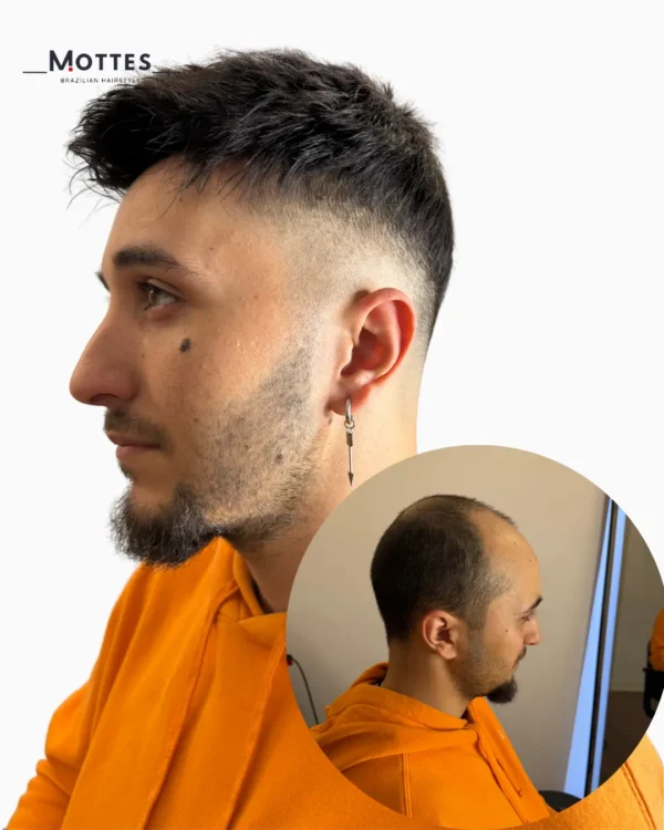 Custom Hair Prosthesis - Image 3