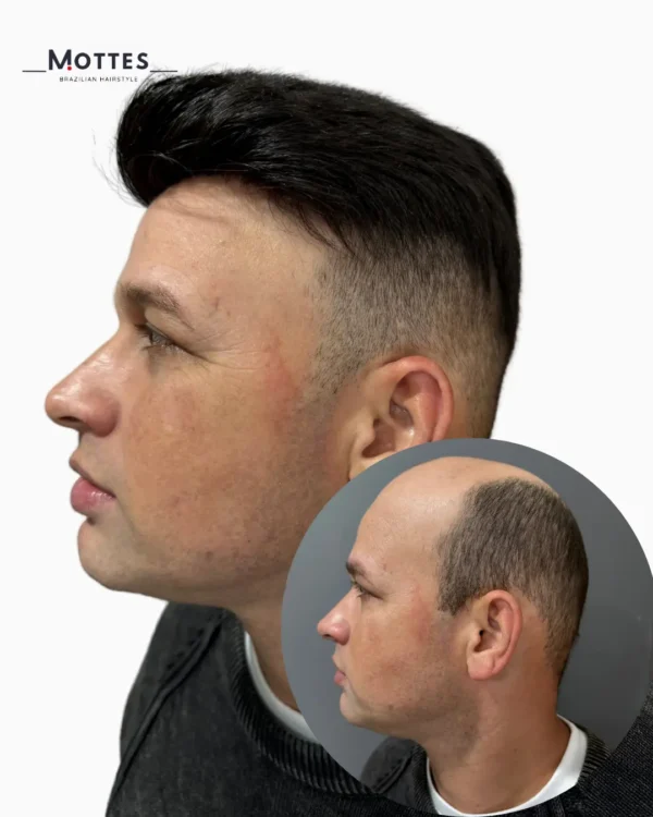 Custom Hair Prosthesis - Image 6