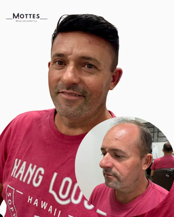 Custom Hair Prosthesis - Image 5