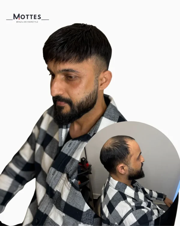 Custom Hair Prosthesis - Image 4