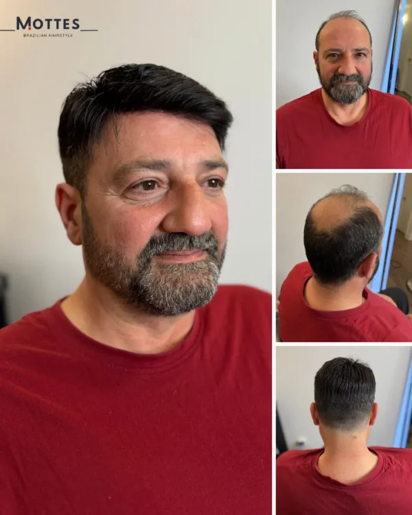 Custom Hair Prosthesis